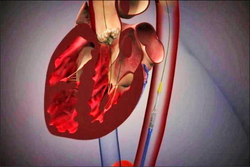 主動脈瓣膜置換手術（TAVR）示意圖。（台大醫院提供）