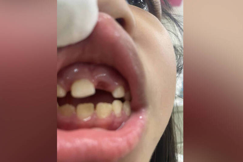 台南女童疑因吃飯太慢遭老師以手拍打嘴巴後，1顆門牙乳牙脫落。（讀者提供；本報合成）