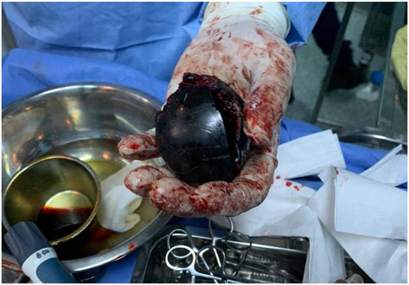 约旦一支医疗团队日前收治了一名51岁男性，主诉为网球大小的塑胶球卡在骨盆里，声称此举是为「治疗痔疮」。（翻摄病例报告）(photo:LTN)