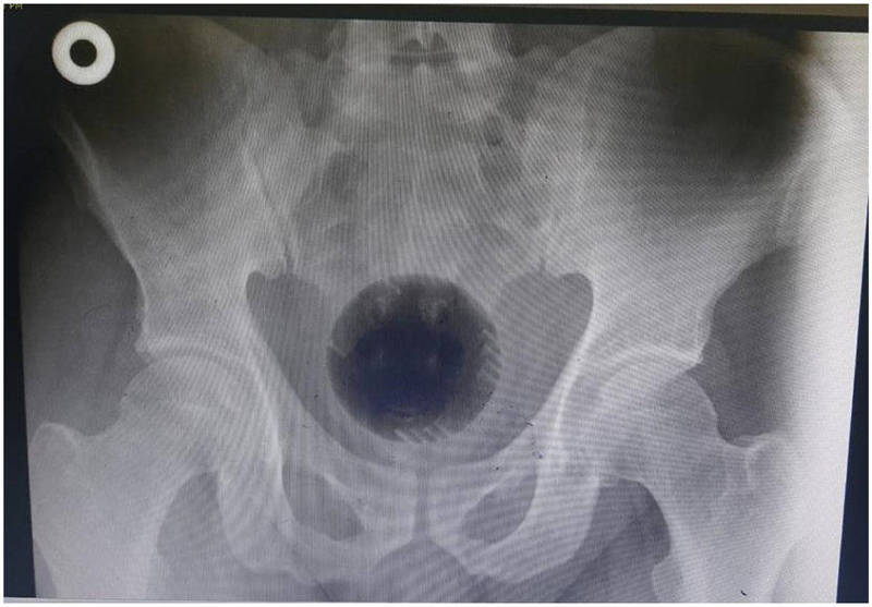 图为患者X光片。（翻摄病例报告）(photo:LTN)