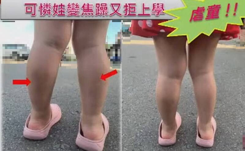 台南市1名2歲女童就讀某私幼的幼幼班，家長發現小孩1星期就拒上學，小腿肚還有大片瘀青。教育局說，已啟動調查。（台南市議員陳碧玉提供）