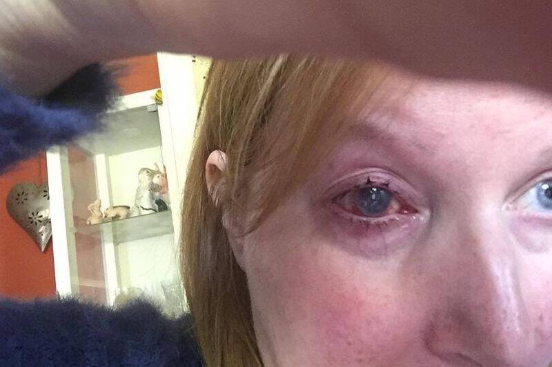 英国1名女子洗澡会戴着隐眼，结果左眼不慎感染棘阿米巴角膜炎，最后眼睛甚至需摘除。（图翻摄自推特）(photo:LTN)