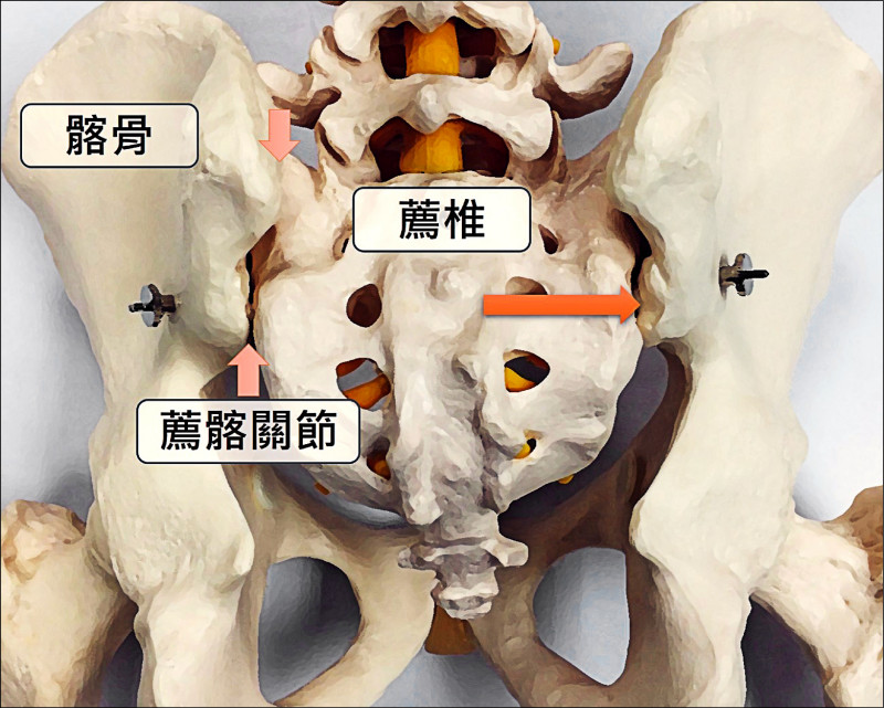 休息也難緩解 薦髂關節炎愈躺愈僵硬 自由健康網