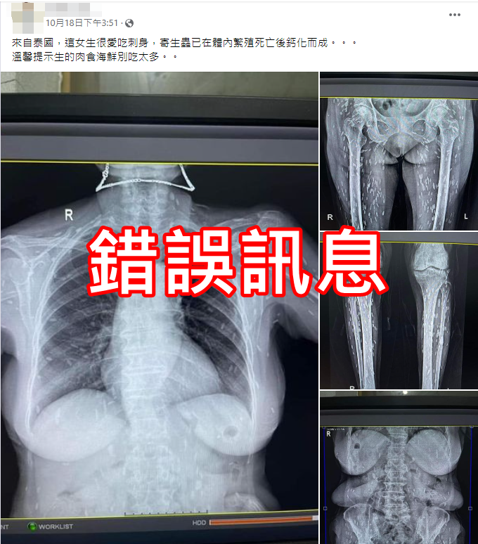 近日网传因喜爱生食导致全身佈满白点的X光照片。经查核中心查证后，确认为错误讯息。（图撷取自台湾事实查核中心）(photo:LTN)