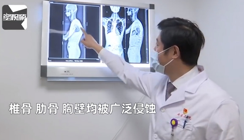 中國男身高180縮成170 竟是脊椎骨自己「消失」