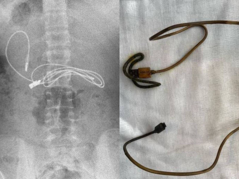 从X光照能发现，少年体内竟卡着一条缠成一团的充电线。（图翻摄自prof.dr.yasardogan IG）(photo:LTN)