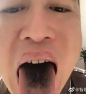 中国疫情大爆发，微博上，有人惊爆染疫后出现舌头发黑。（图撷取自微博）(photo:LTN)