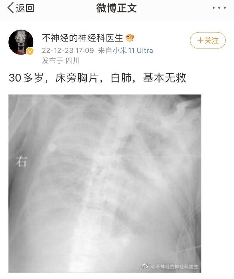 四川医生在微博发佈病患的X光照。（图撷取自微博）(photo:LTN)