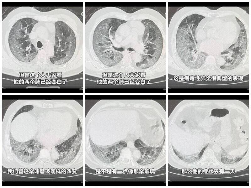 中国医护人员在微博爆料，染疫者被诊断出严重肺炎，甚至出现极端的「白肺」症状。（图撷取自微博）(photo:LTN)
