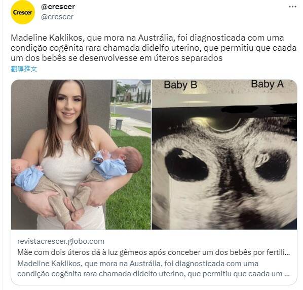 澳洲24歲女子卡莉克斯天生擁有2個子宮造成難以受孕，她與先生努力經過多年努力，分別透過試管嬰兒和自然受孕，同時讓2個子宮都懷上1個孩子，並在今年2月順利生下這對雙胞胎男嬰。（圖擷取自「@crescer」推特）