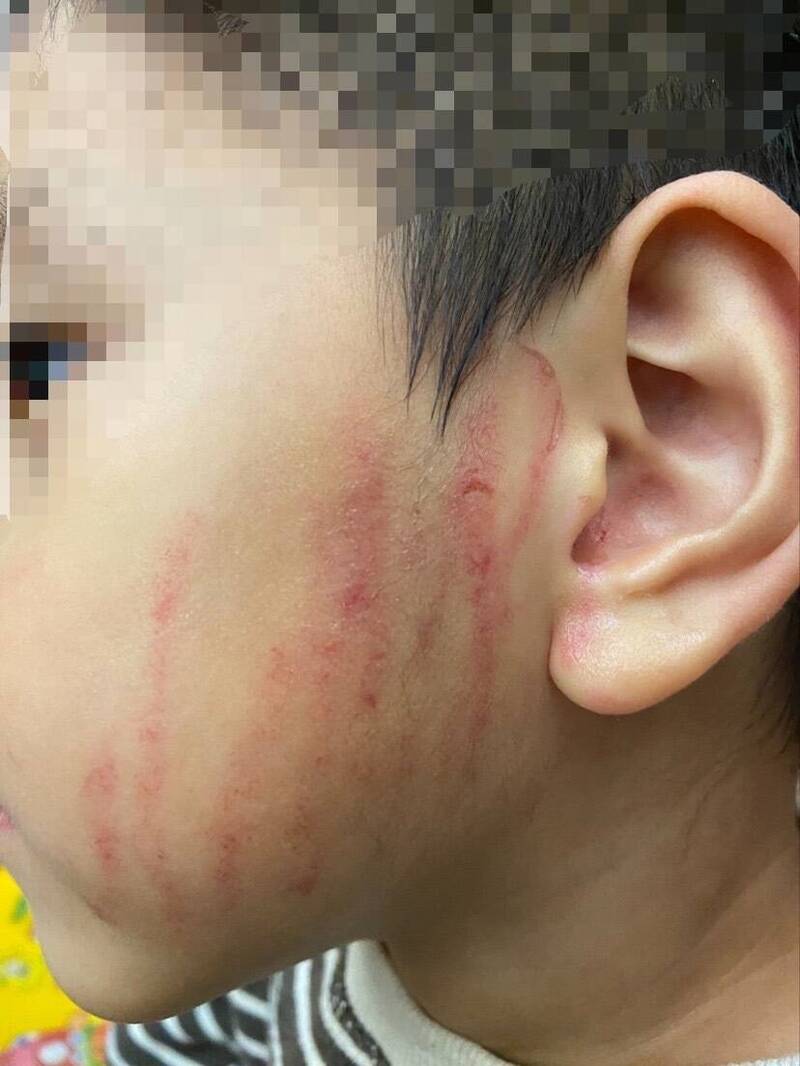 男童左臉頰被劉姓女幼保員抓傷。（家長提供）