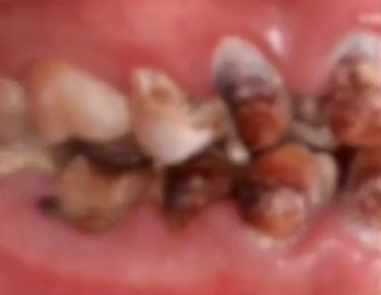 中国浙江一名22岁女子一年多来「把可乐当水喝」，导致全口牙齿大面积缺损，严重腐蚀。（图片撷取自微博-中国蓝新闻）(photo:LTN)