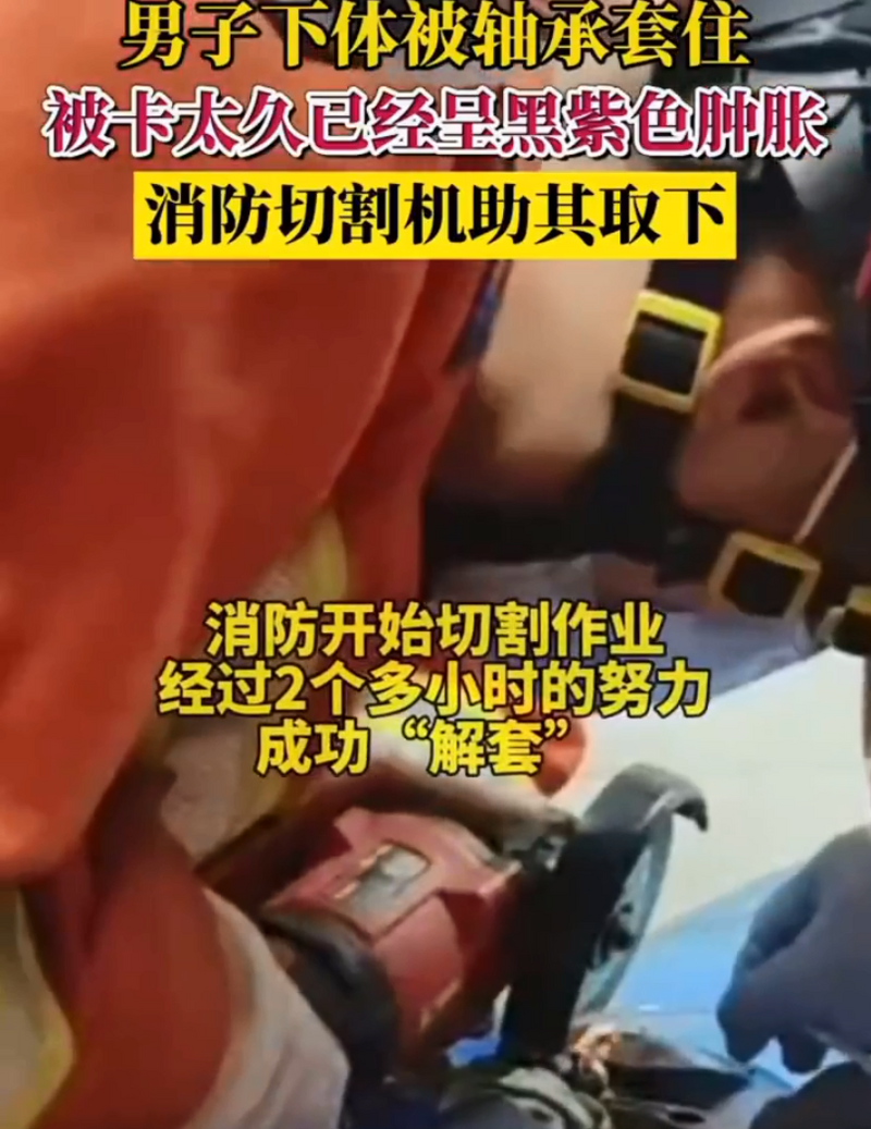 經過2個多小時的「交戰」後，軸承順利取下，男子的命根子總算保住。（圖翻攝自微博）