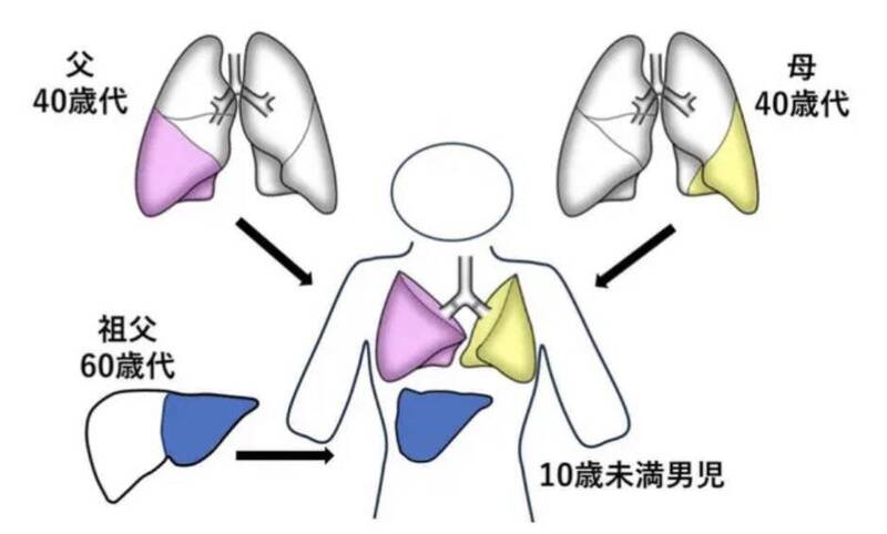 一名先天罹患罕見疾病、未滿10歲的男童，在收到雙親及祖父所捐的部分肺與肝後，於去年11月接受院方「同時進行活體移植」的手術。（圖擷取自@EARL_med_tw 社群平台「X」）
