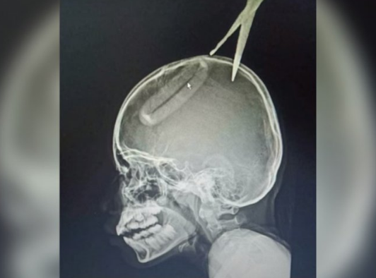 泰國4歲男童模仿某電影劇情「射飛刀」,卻意外將剪刀射進10歲姊姊的頭骨內。(圖片擷取自X平台@asiaonecom) 泰國4歲男童模仿某電影劇情「射飛刀」,卻意外將剪刀射進10歲姊姊的頭骨內。(圖片擷取自X平台@asiaonecom)