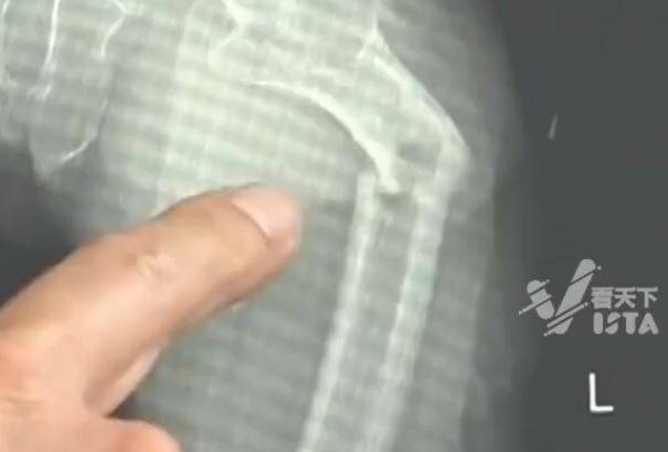 中國一名35歲男子,在家劇烈咳嗽後,大腿骨竟斷成兩截。(圖擷取自微博) 中國一名35歲男子,在家劇烈咳嗽後,大腿骨竟斷成兩截。(圖擷取自微博)