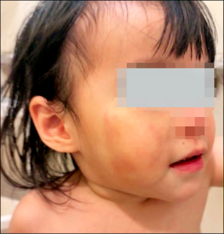 家長指至幼兒園接女兒時，發現女兒臉頰有明顯咬痕。（議員張嘉玲提供）