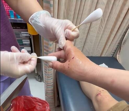 婦人手部遭咬傷。(翻攝臉書苗栗大小事) 婦人手部遭咬傷。(翻攝臉書苗栗大小事)
