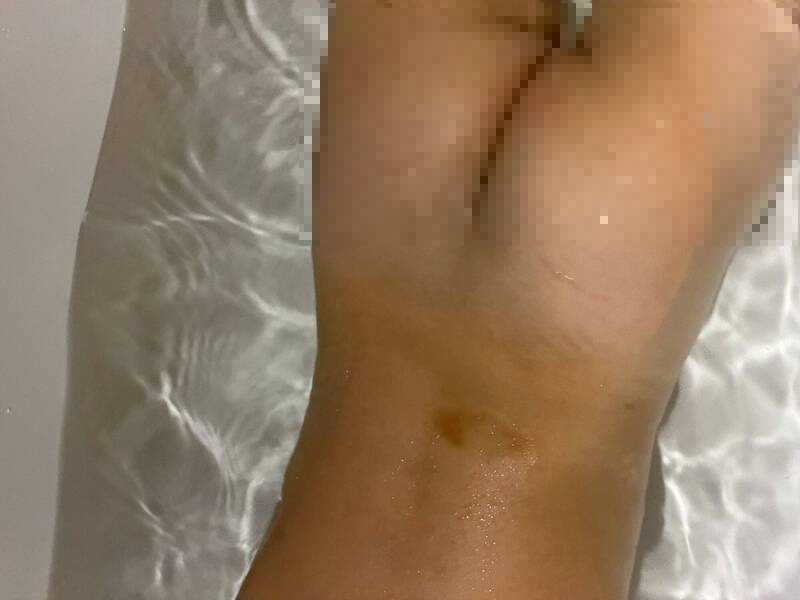 新竹市再传私立幼儿园老师对幼童施暴, 数名幼童遭闪耳光捏大腿转耳朵,身体也出现多处淤青。(读者提供) 新竹市再传私立幼儿园老师对幼童施暴, 数名幼童遭闪耳光捏大腿转耳朵,身体也出现多处淤青。(读者提供)