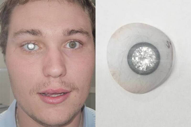 美国一名年轻珠宝设计师右眼失明后,斥资200万美元(约新台币6146万元)打造镶有2克拉天然钻石的义眼。(本报合成,图撷自@artificialeyesbyjohnimm/IG) 美国一名年轻珠宝设计师右眼失明后,斥资200万美元(约新台币6146万元)打造镶有2克拉天然钻石的义眼。(本报合成,图撷自@artificialeyesbyjohnimm/IG)