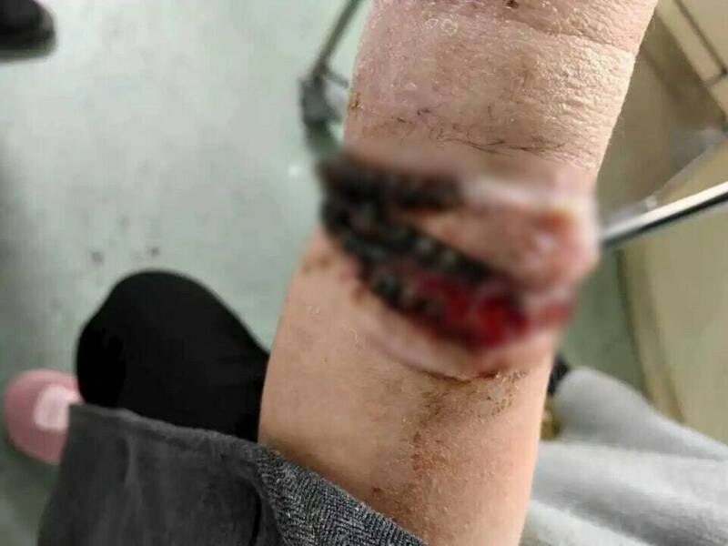 手镯和串珠链「长」进肉里。（图：福建卫生报）