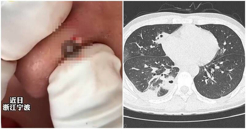 痘痘別亂擠!男大生擠完發燒、胸刺痛進ICU 醫驚見肺部破10多洞
