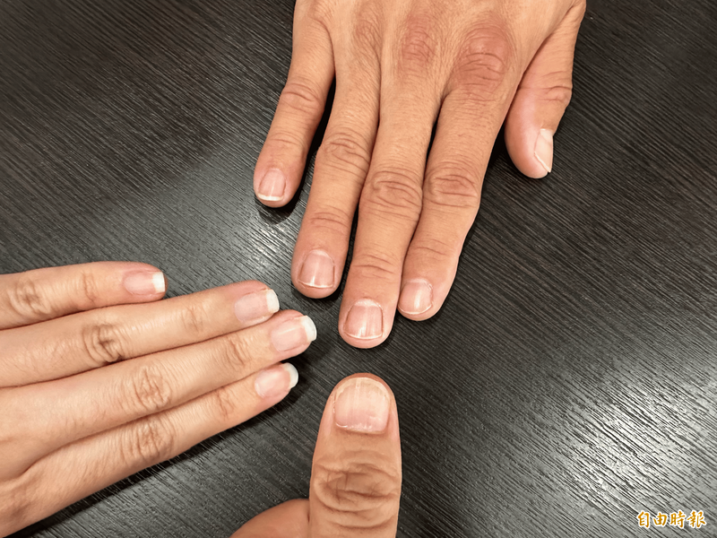 台灣人旅日頻傳「指甲倒刺災情」 一票人狂推各種小物緩減傷害