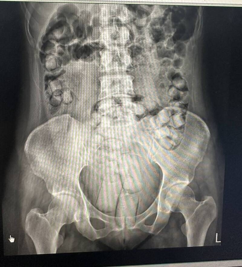 一顆都不能少!2泰女體內藏105顆海洛因 耗費10多小時排出