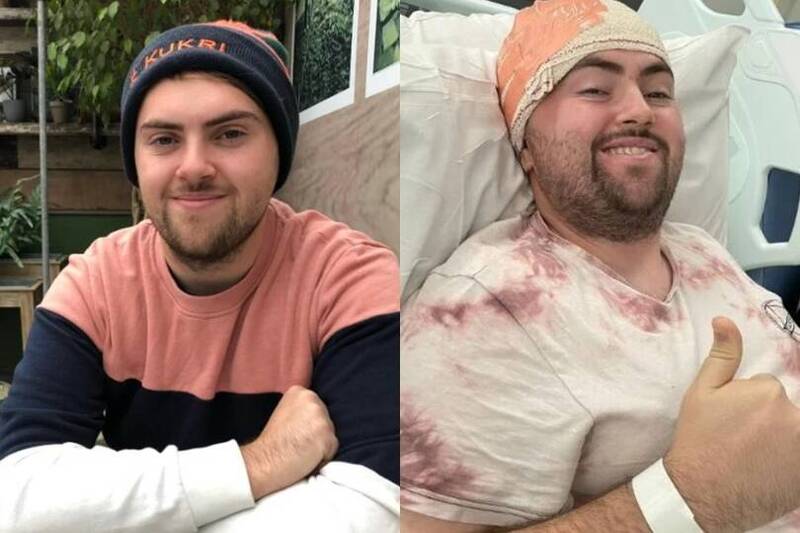 以為重訓拉傷!英男頭痛發麻半年竟是惡性腦瘤 醫宣告:壽命剩10年