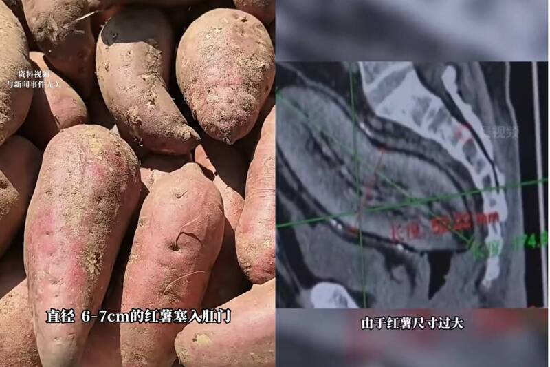 深夜往肛門塞「17公分地瓜」 中國61歲阿北睡到一半腹痛送醫