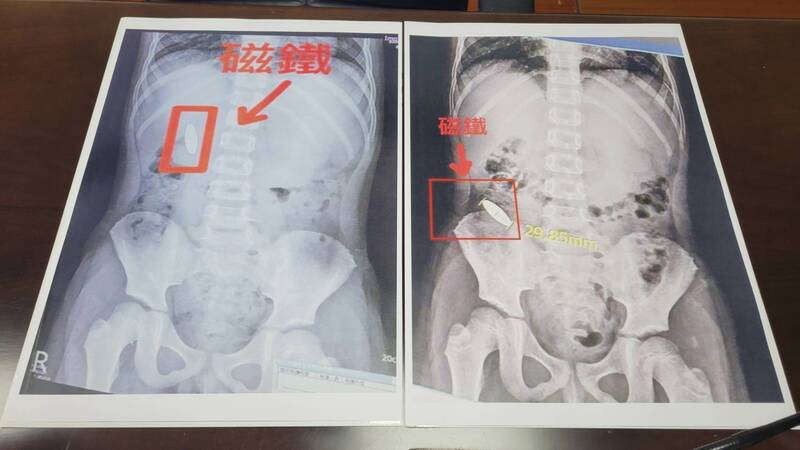 南市小一生被逼吞磁鐵 半夜驚醒「會不會卡在肚子不出來」