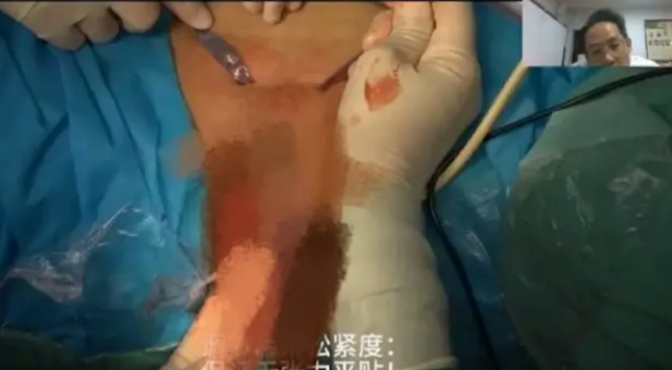 手術直播變色情片?畫面突現女病患私密處 吸5萬網友湧入搶看