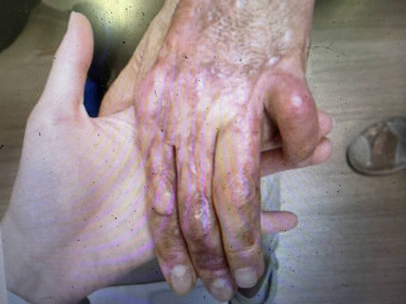 前妻恐怖逆襲! 熟睡人夫被潑滾燙熱水逾50%燒傷