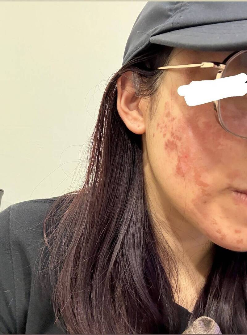 果酸換膚拿錯濃度害女子臉灼傷 高雄市衛生局查化粧品過期要罰