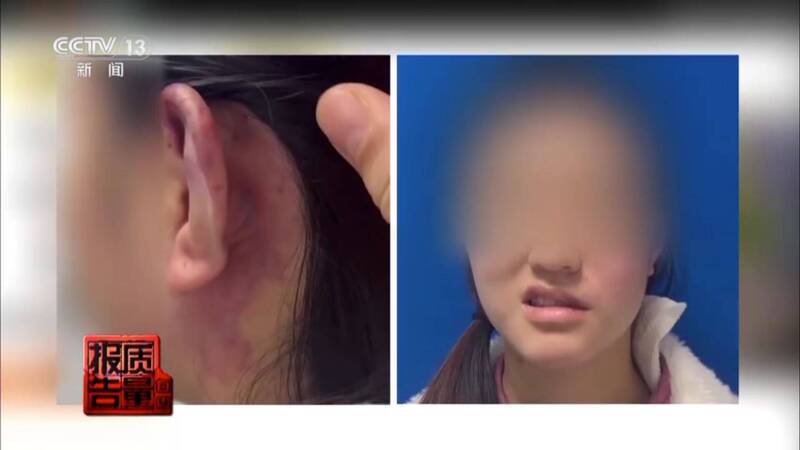 中國瘋整形「精靈耳」 醫揭多人術後終身殘疾慘案