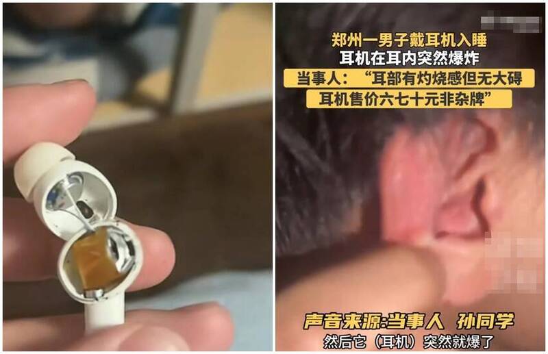 男大生戴上中國「熱銷數百萬」藍芽耳機 在耳中無預警爆炸