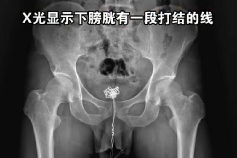 太扯!中國男「25公分傳輸線」塞尿道 卡12小時痛到掛急診