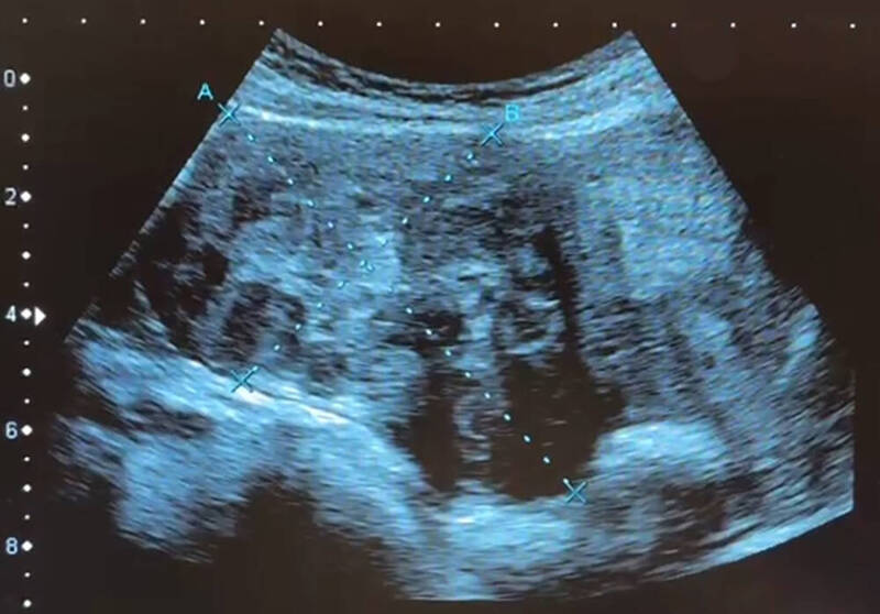 肚子凸起以為變胖! 中國42歲女就醫開刀竟取出50個子宮肌瘤