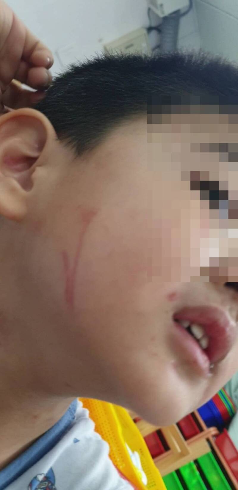 4歲特教童滿臉傷!教師「10度不當管教」 僅罰3.6萬將復職