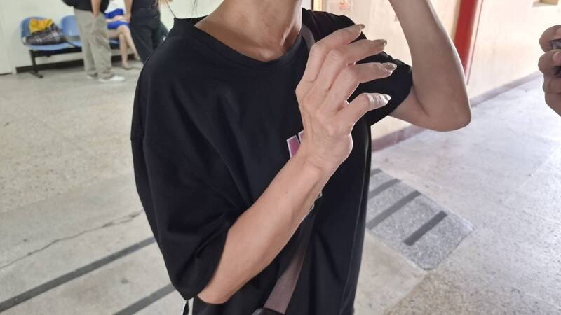 45歲婦醫美割眼袋突呼吸困難 胃大出血住院11天不治 檢將解剖