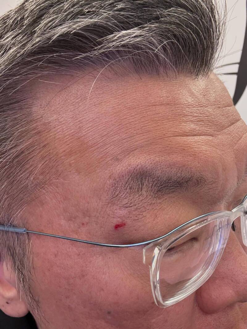 被12強冠軍獎盃砸到眼角流血 蔡其昌：光榮印記！