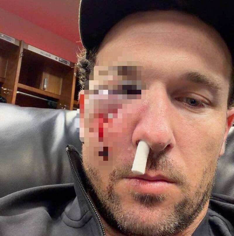 MLB》要季後賽了卻出事!55億重砲慘遭隊友界外球直擊破相(影音)