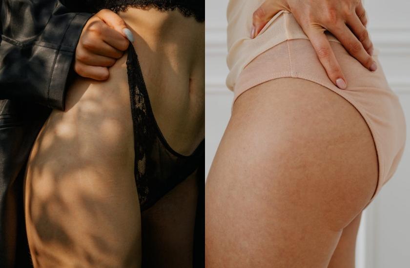 橘皮組織是因皮下脂肪堆積、擠壓到上方的皮膚表層所導致。（翻攝自pexels）