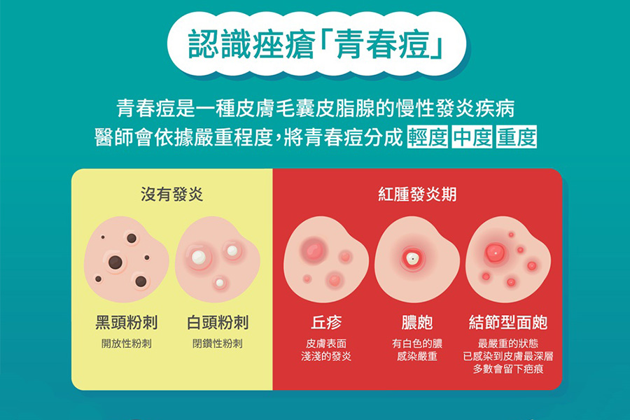 不再為「痘」所憂  醫推薦：用這抗痘治療效果好