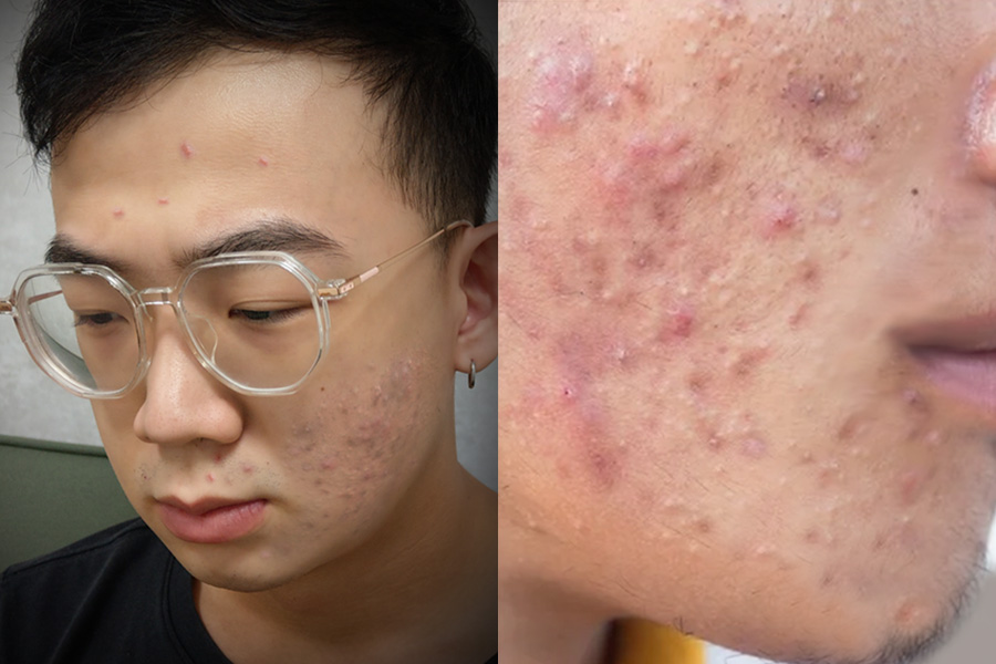 痘花臉宅男靠它「抗痘」對比照超驚人