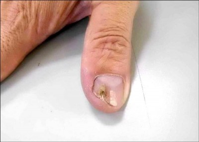 醫療新知與日常保健》不再讓灰指甲影響你的指尖風情