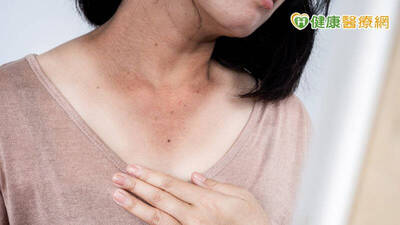 健康醫療網》不只日曬 食藥署揭「黑色素」生成原因！可以用食材敷臉變白嗎？