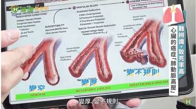 健康醫療網》罕病肺動脈高壓可致心衰竭！成大醫院打造整合照護 助患者回歸人生正軌