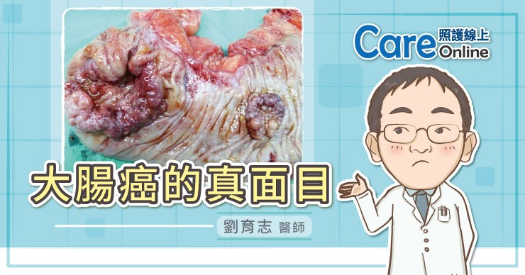照護線上 大腸癌的真面目 真實照片 慎入 自由評論網