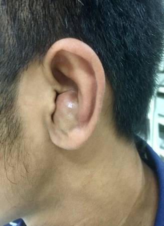 健康醫療網 柔道耳是什麼 醫 耳廓假性囊腫 自由評論網